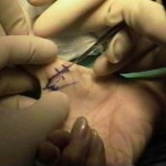 Trigger Finger Surgery 300x255 150x150 Trigger thumb surgery performed with simple local anaesthesia