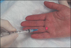 Steroid injections and diabetes